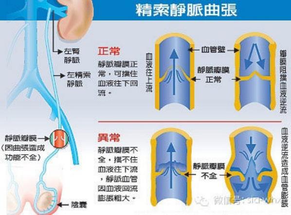 關(guān)于2021年征兵精索靜脈曲張標(biāo)準(zhǔn)的探討，2021年征兵精索靜脈曲張標(biāo)準(zhǔn)深度解析