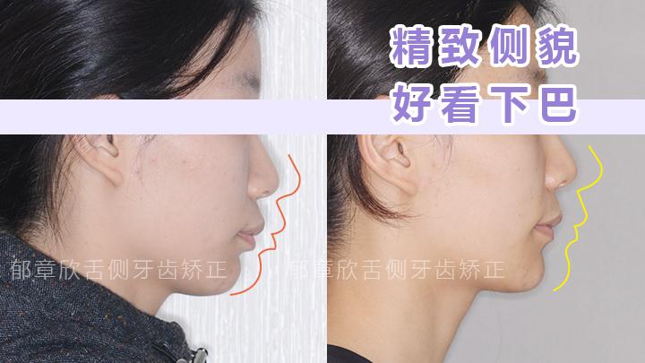 下巴后縮矯正方法詳解，下巴后縮矯正方法全面解析