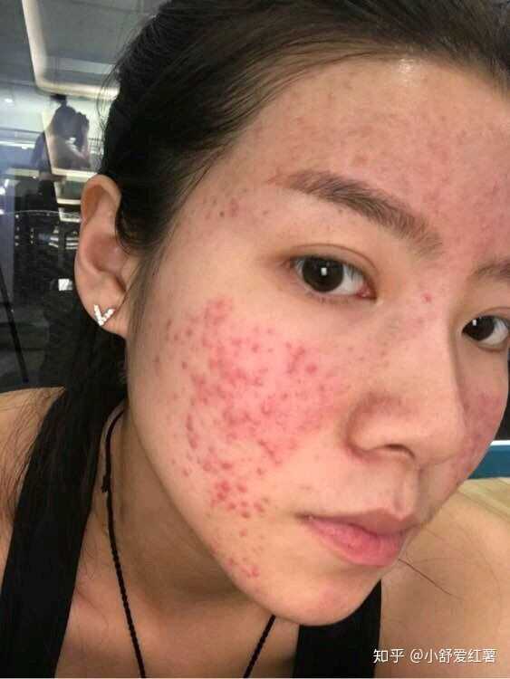 如何有效去除臉上的痘印——全方位指南，全方位指南，如何有效去除臉上痘印的方法