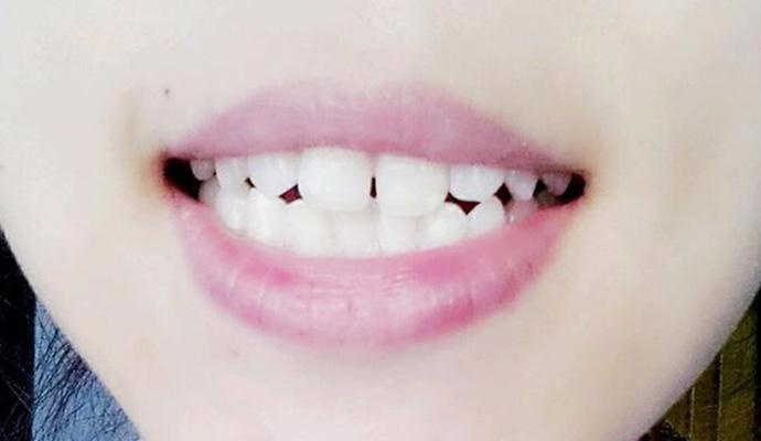 門牙縫變小自然方法