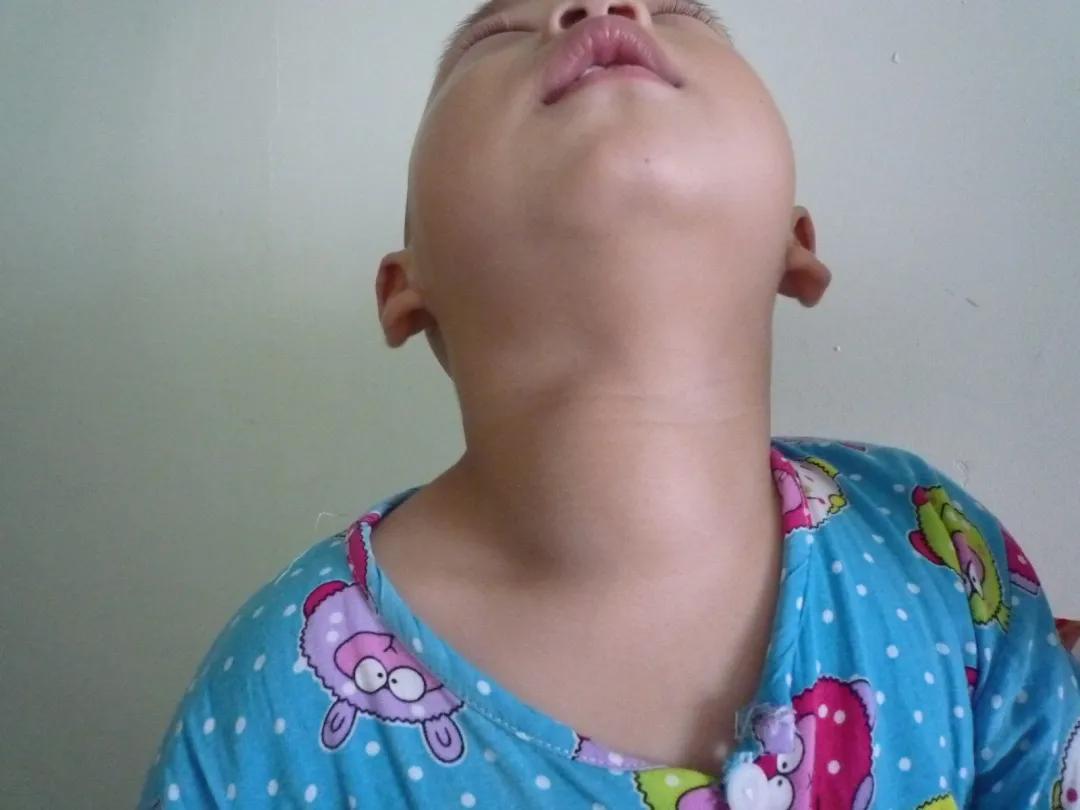 甲狀腺結(jié)節(jié)