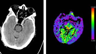 腦CT沒事就代表大腦沒事嗎？深入探討腦部健康與CT檢查的關(guān)系，腦部健康與CT檢查，CT無異常是否代表大腦無隱患？