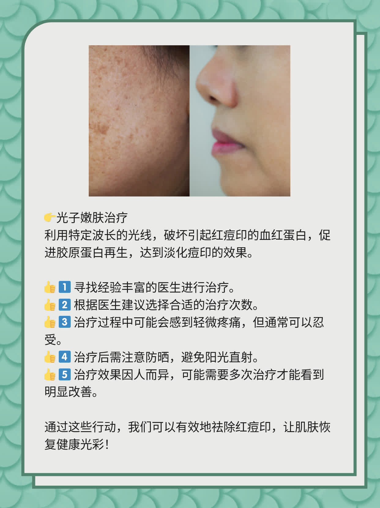 如何有效去除紅痘印，一站式解決方案，一站式解決紅痘印問題，有效去除方法大全