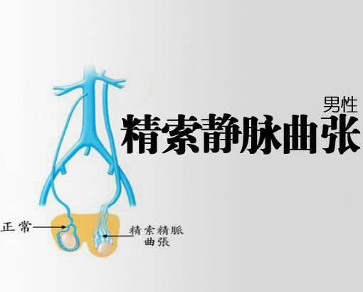精索靜脈曲張的癥狀表現(xiàn)及其影響，精索靜脈曲張的癥狀表現(xiàn)及其潛在影響
