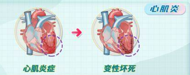 女性心肌炎的癥狀表現(xiàn)及其重要性，了解、預(yù)防與治療，女性心肌炎的癥狀、重要性，了解、預(yù)防與治療全攻略