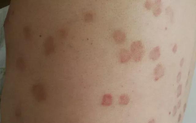 皮膚癬初期圖片及識別指南，皮膚癬初期癥狀圖片與識別指南