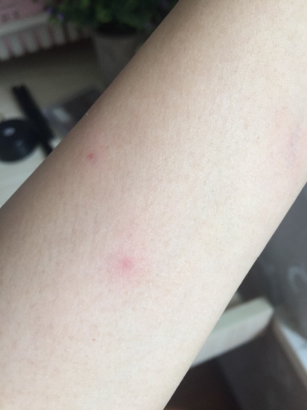 身上紅點(diǎn)不痛不癢圖片，原因、識(shí)別與處理方法，身上紅點(diǎn)無(wú)痛癢，識(shí)別、原因及處理方法