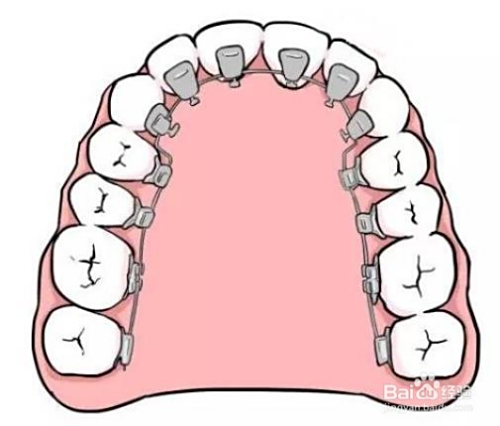 牙套價格詳解，裝一個牙套需要多少錢？，牙套價格全解析，裝牙套需要多少錢？