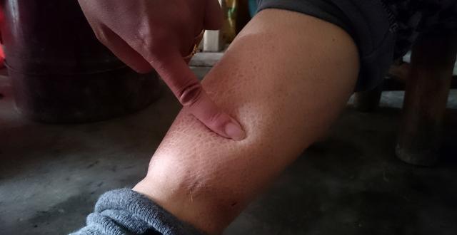 小腿浮腫一按一個坑，原因、治療與預防，小腿浮腫原因、治療及預防方法，一按一個坑的困擾