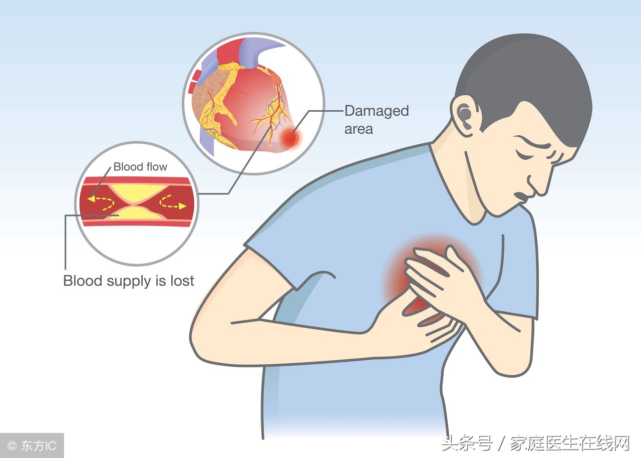 心肌梗塞的最佳治療方法，心肌梗塞的最佳治療方法解析