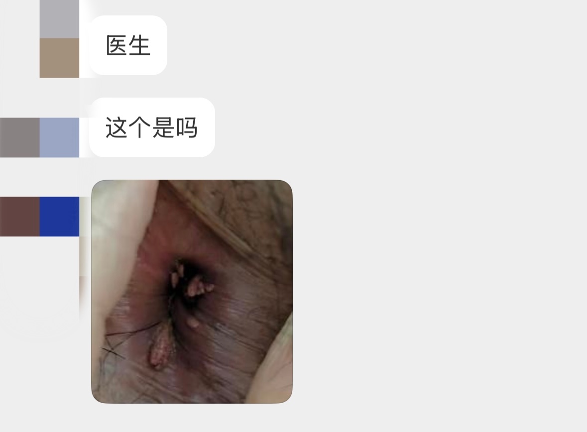 如何判斷得了肛門(mén)疣——癥狀、診斷與應(yīng)對(duì)策略，肛門(mén)疣的癥狀、診斷及應(yīng)對(duì)策略指南