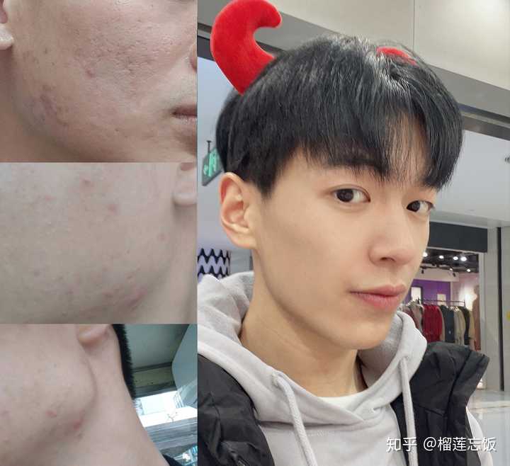 如何有效去除臉上的痘印——全方位指南，全方位指南，如何有效去除臉上痘印的方法