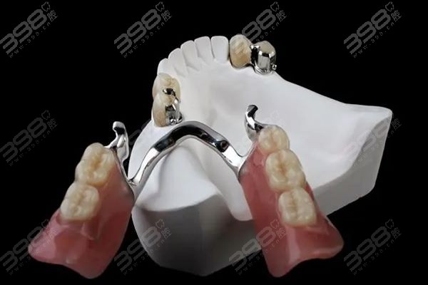 鑲一顆牙大概需要多少錢——全面解析鑲牙費(fèi)用因素，鑲一顆牙的費(fèi)用解析，全面探討鑲牙費(fèi)用因素及大概價(jià)格