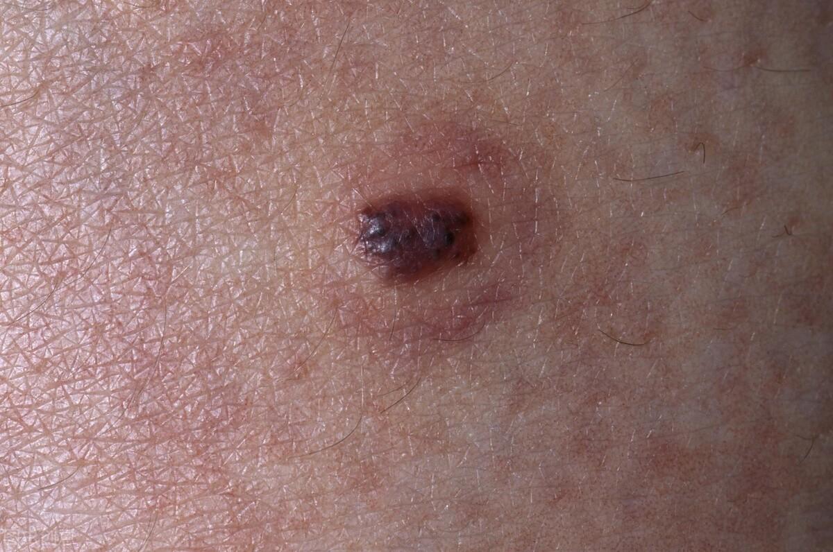 血痣和紅痣的區(qū)別圖片，深入了解兩種皮膚狀況，血痣與紅痣的區(qū)別詳解，專業(yè)圖片解析，深入了解兩種皮膚狀況特征