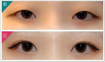 割雙眼皮多少錢(qián)呢？全面解析雙眼皮手術(shù)費(fèi)用因素，雙眼皮手術(shù)費(fèi)用全面解析，了解割雙眼皮的價(jià)格與影響因素