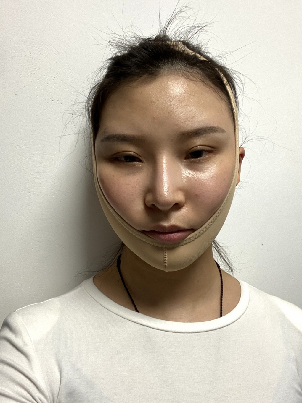 面部吸脂十天后的變化，圖片與經(jīng)驗分享，面部吸脂十天，變化、圖片與經(jīng)驗分享