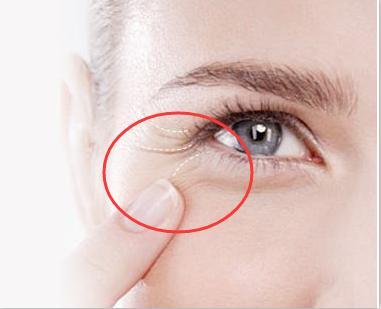 如何去除魚尾紋，最佳方法與實用建議，去除魚尾紋，最佳方法與實用建議攻略