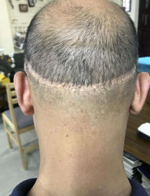 植發(fā)效果的持久性，能否長期維持與多種因素相關(guān)，植發(fā)效果的持久性與多種因素關(guān)聯(lián)，長期維持探討