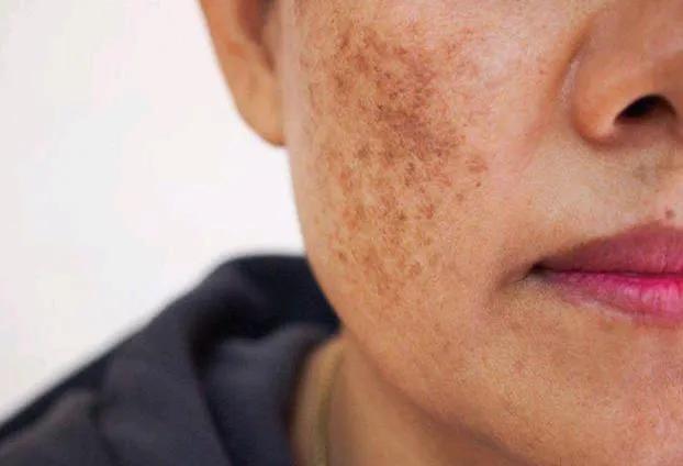 最簡單除老年斑的偏方，最簡單有效的老年斑去除偏方