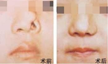 鼻整形手術(shù)費(fèi)用詳解，多少錢？一切因素告訴你！，鼻整形手術(shù)費(fèi)用全面解析，價(jià)格因素一網(wǎng)打盡！